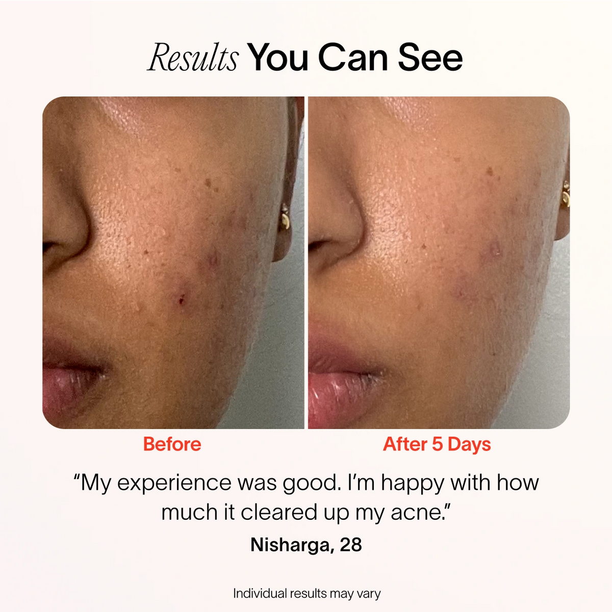 4-Minute Pimple Spot Treatment